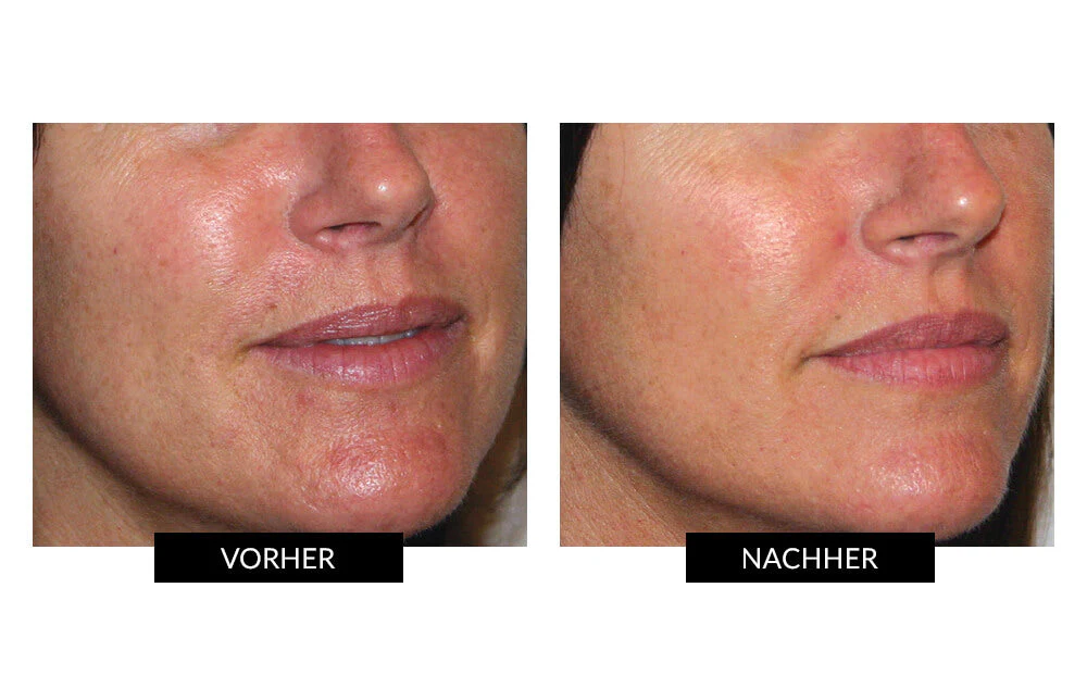 CurrentBody Skin LED Lichttherapie Masker + Hydrogel - Image 10