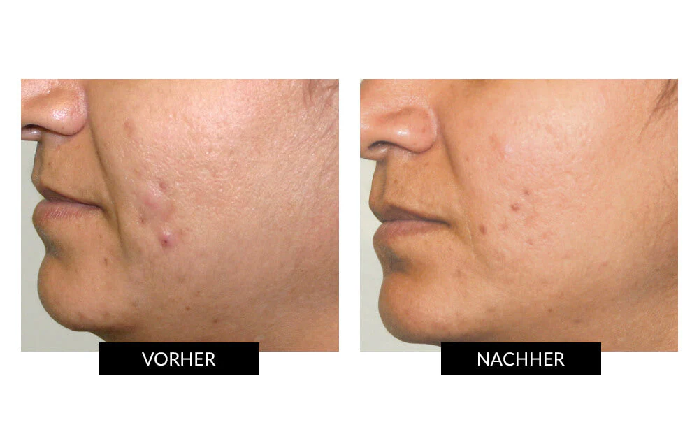 CurrentBody Skin LED Lichttherapie Masker + Hydrogel - Image 11