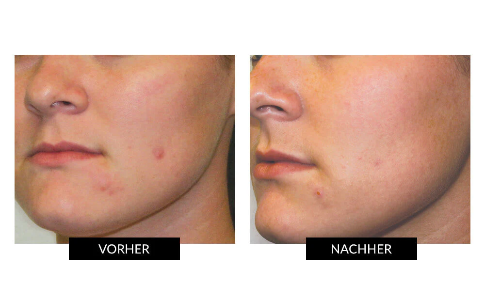 CurrentBody Skin LED Lichttherapie Masker + Hydrogel - Image 12