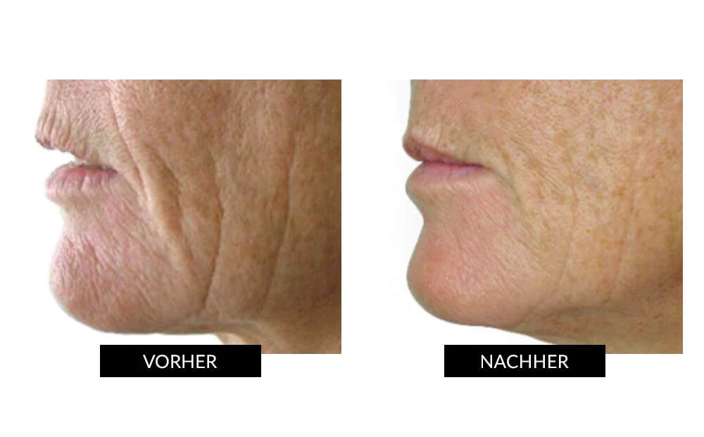 CurrentBody Skin LED Lichttherapie Masker + Hydrogel - Image 6