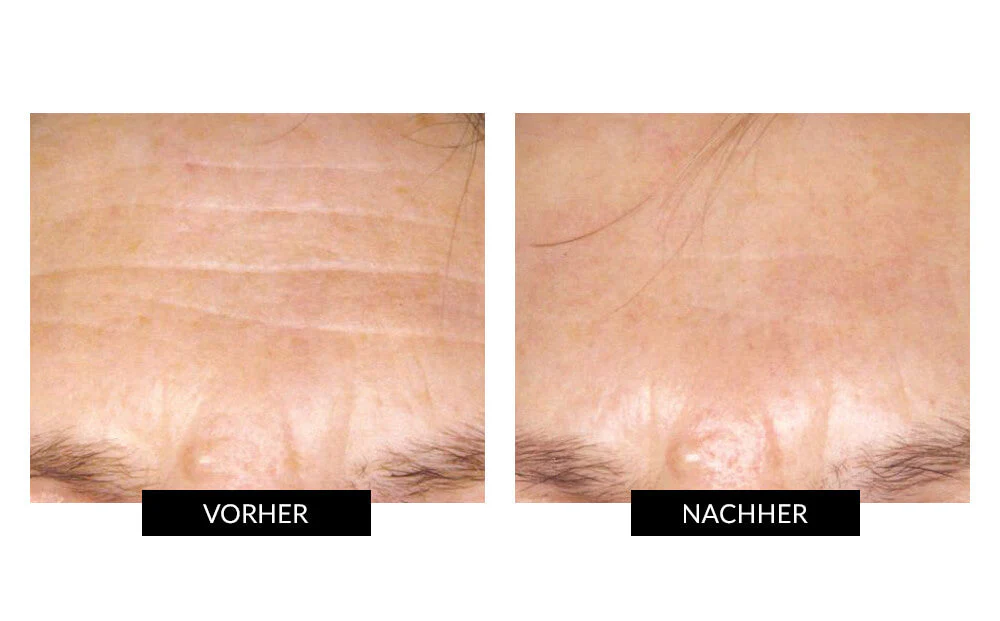 CurrentBody Skin LED Lichttherapie Masker + Hydrogel - Image 7