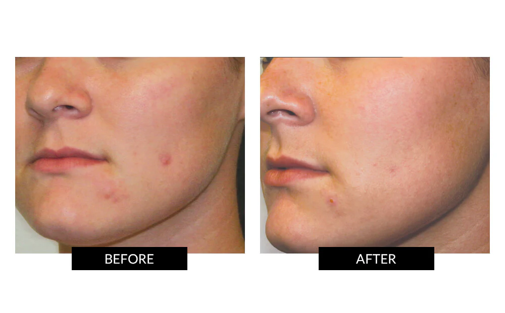 CurrentBody Skin LED Light Therapy Mask + Hydrogel - Image 10