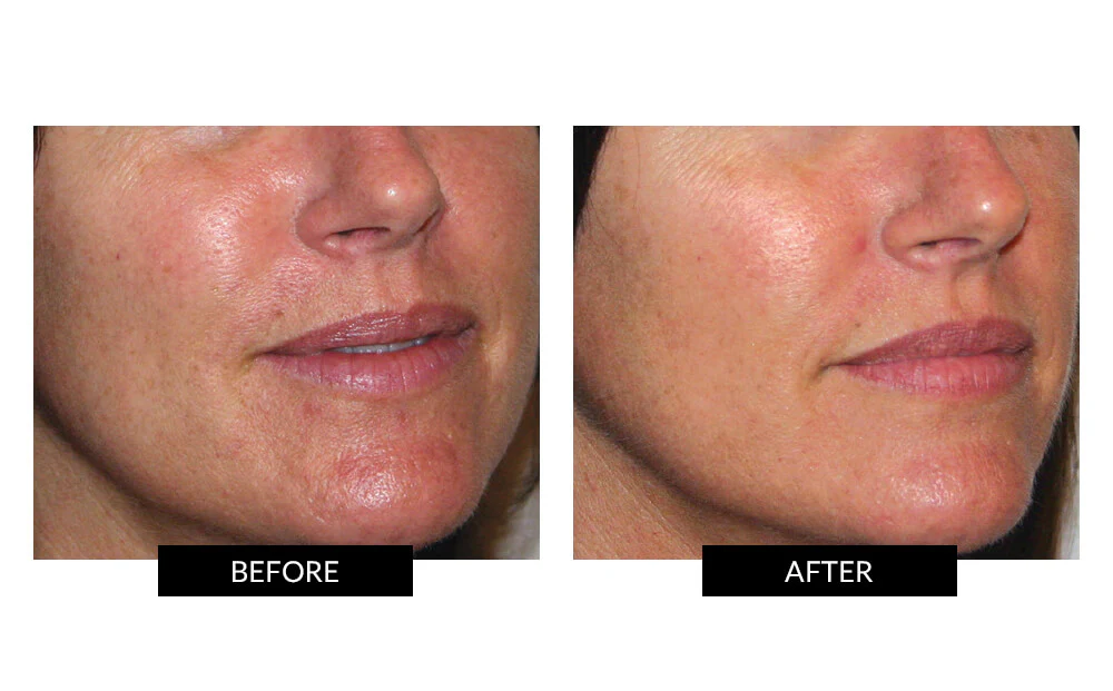 CurrentBody Skin LED Light Therapy Mask + Hydrogel - Image 7