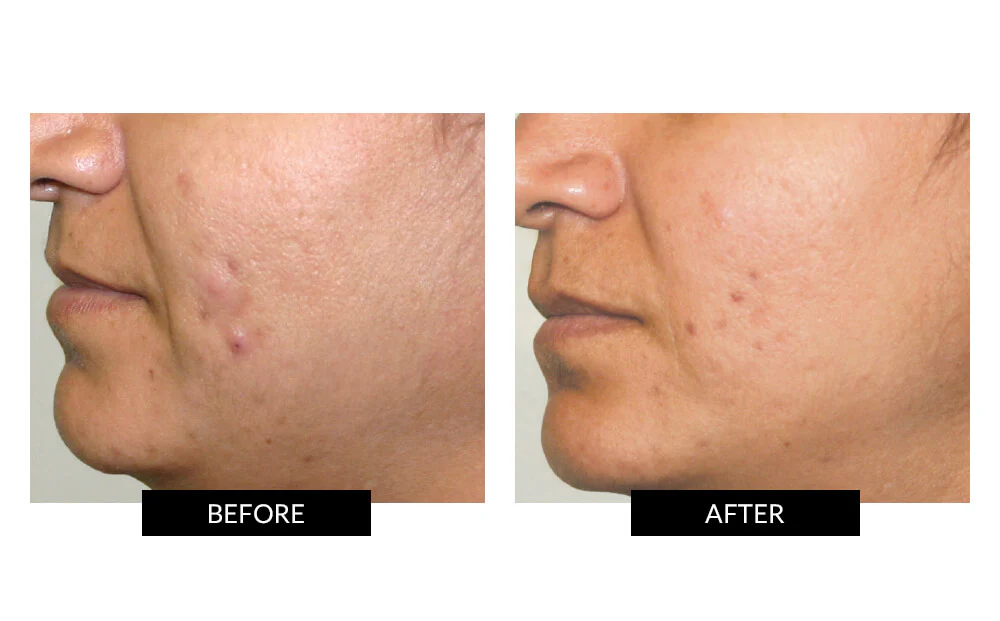 CurrentBody Skin LED Light Therapy Mask + Hydrogel - Image 9